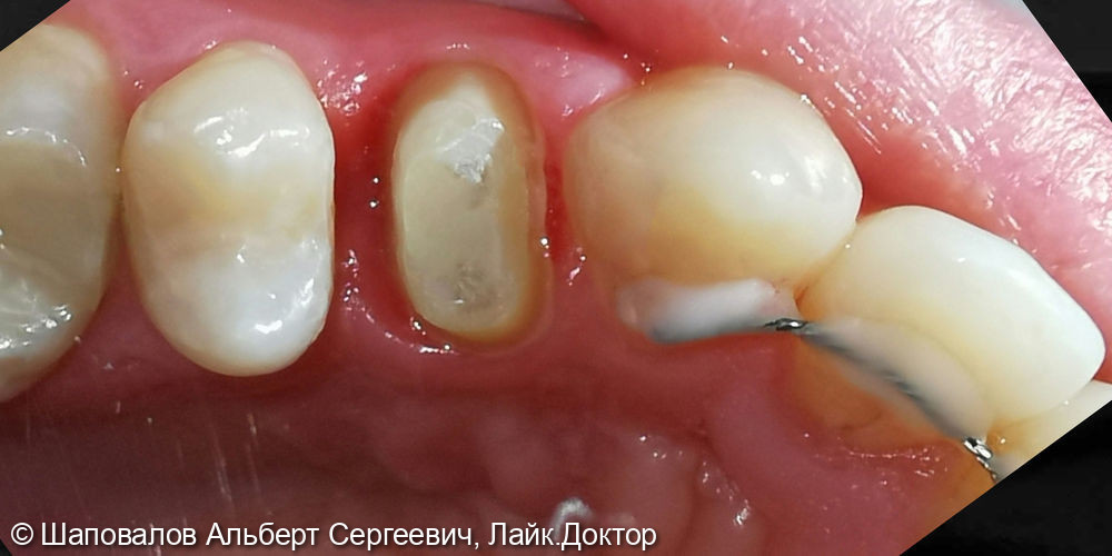 Протезирование зуба 1.4 - фото №1