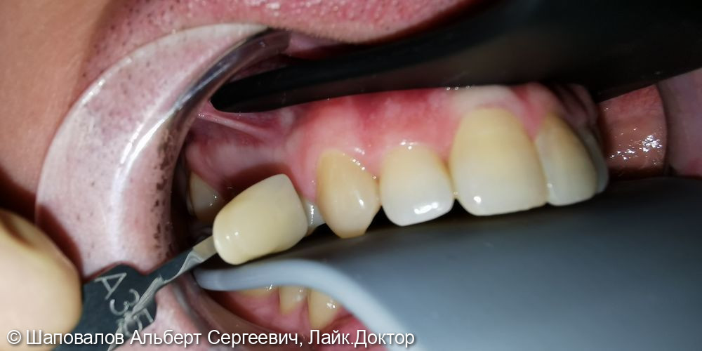 Протезирование зуба 1.4 - фото №2