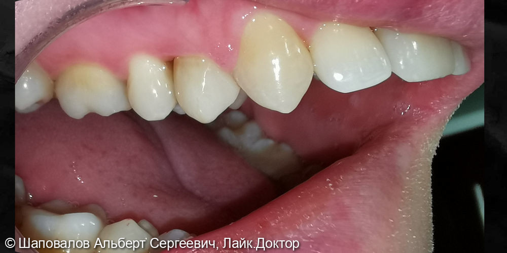 Протезирование зуба 1.4 - фото №5