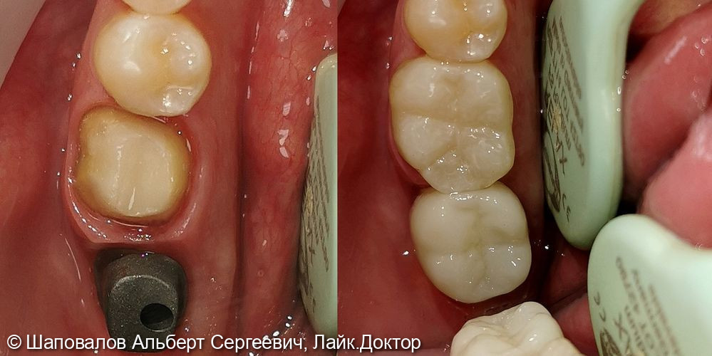 Протезирование на имплантате и на зубе - фото №1