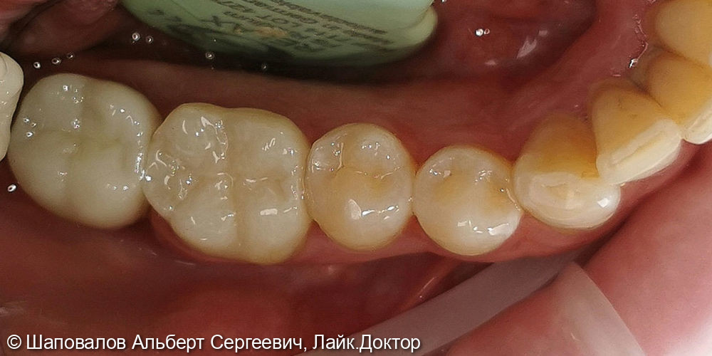 Протезирование на имплантате и на зубе - фото №3