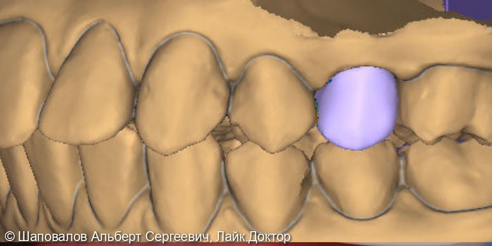 Протезирование невитального зуба цельнокерамической коронкой emax - фото №1