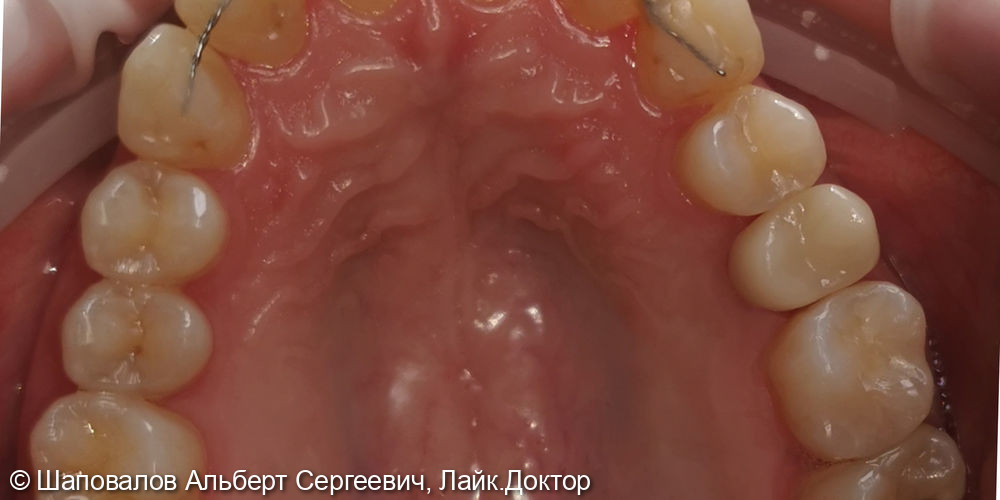 Протезирование невитального зуба цельнокерамической коронкой emax - фото №3