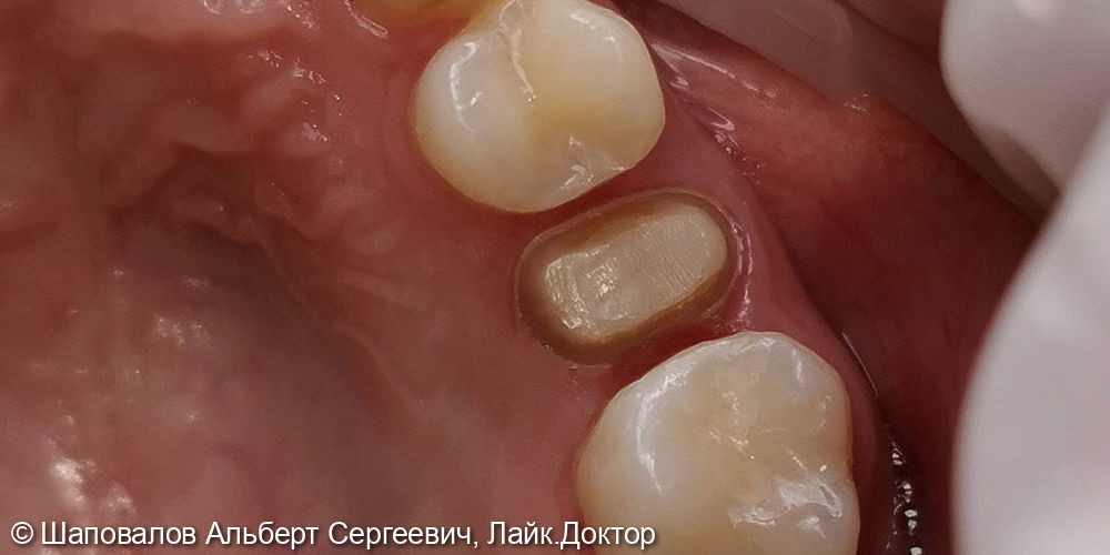 Протезирование невитального зуба цельнокерамической коронкой emax - фото №4