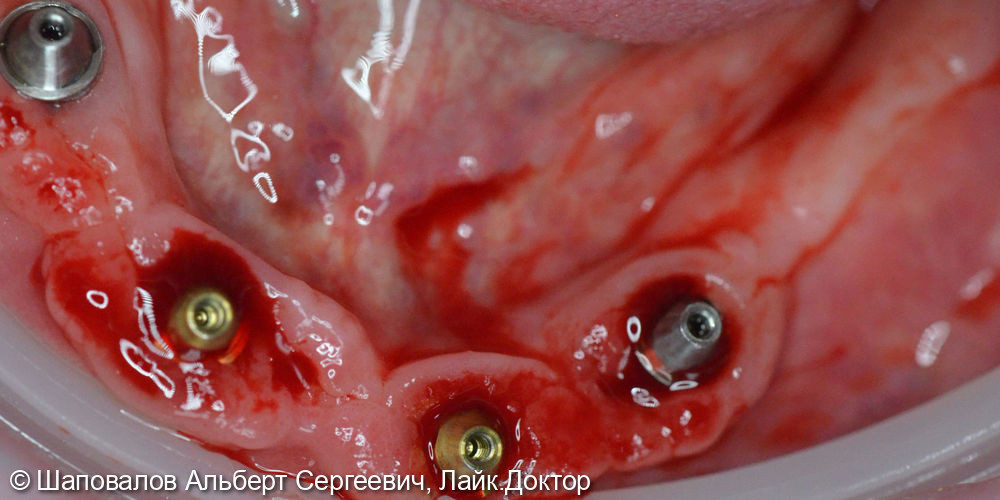 Протезирование всё на 4х имплантах, замена временных протезовных - фото №7