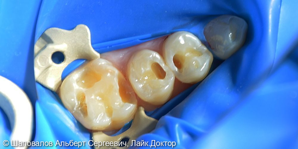 Лечение кариеса нескольких зубов - фото №1