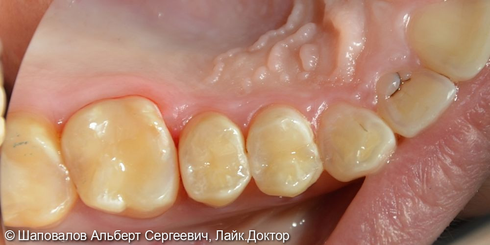 Лечение кариеса нескольких зубов - фото №3