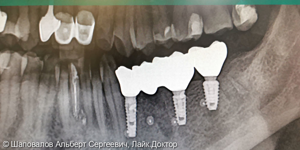 Имплантация, восстановление концевого дефекта - фото №1