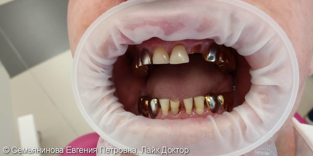Реставрация на корне зуба с использованием штифта и светоотверждаемого композиционного материала Filtek Ultimate - фото №1