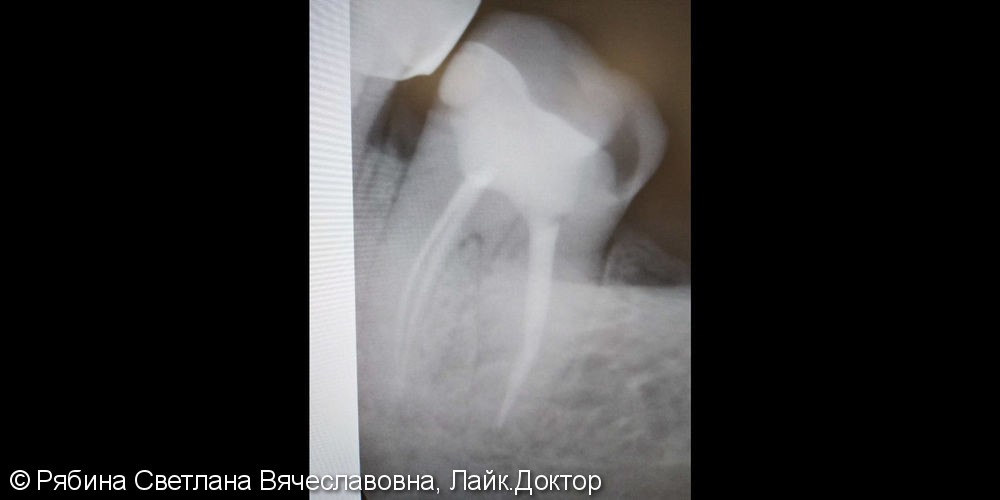 Восстановление разрушенного зуба под коронку (билдап) - фото №1