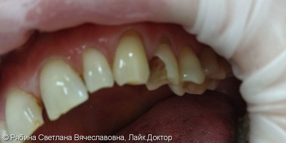 Восстановление 2.4 зуба с помощью анкерного штифта, Filtek Ultimate А3 - фото №1