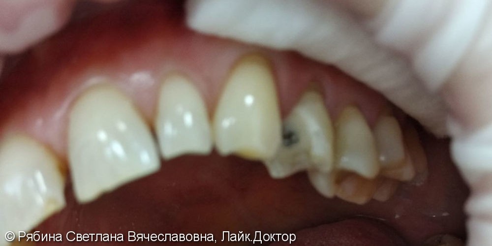 Восстановление 2.4 зуба с помощью анкерного штифта, Filtek Ultimate А3 - фото №2