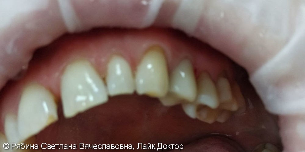 Восстановление 2.4 зуба с помощью анкерного штифта, Filtek Ultimate А3 - фото №3