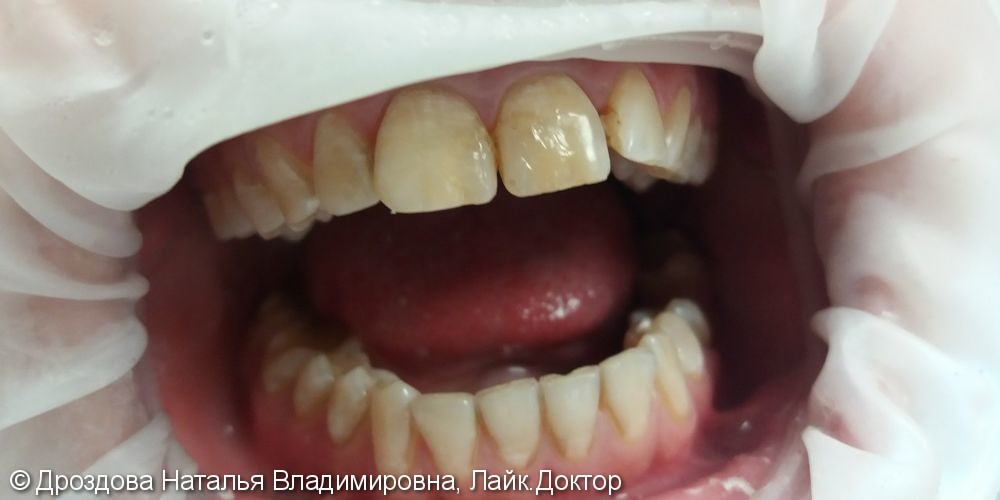 Эндодонтическое отбеливание 11 и 21 зубов, реставрация 12, 11, 21,22 наногибридный светокомпозит и глазурь Boston - фото №1