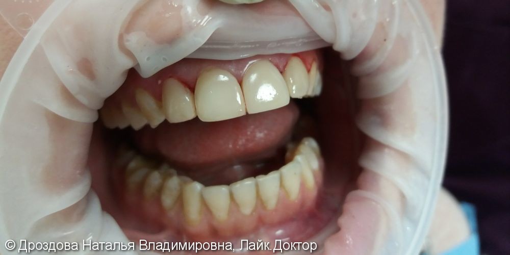 Эндодонтическое отбеливание 11 и 21 зубов, реставрация 12, 11, 21,22 наногибридный светокомпозит и глазурь Boston - фото №2