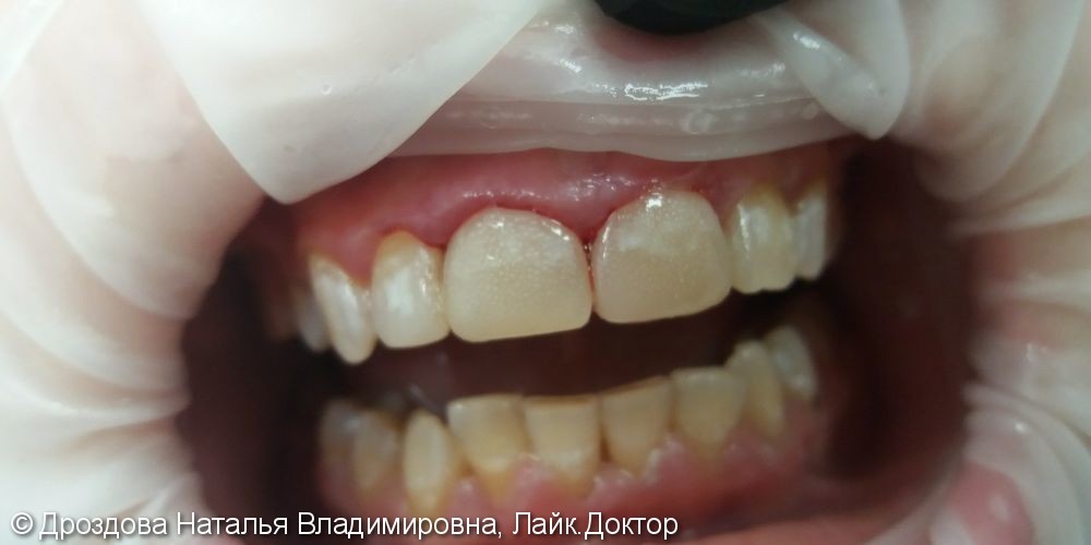 Диастема в области 11, 21 зубов - фото №2