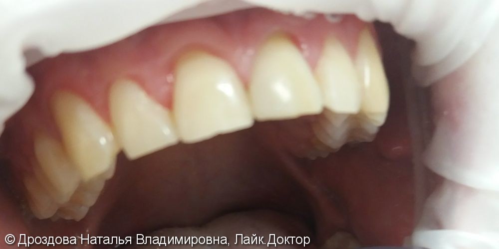 Эндодонтическое отбеливание 21 зуба - фото №2