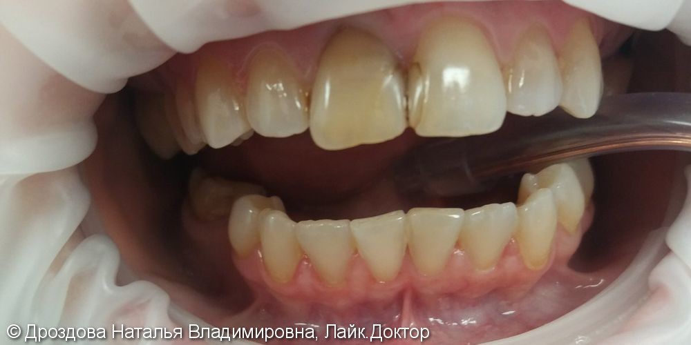 Внутрикоронковое отбеливание 11 зуба и художественная реставрация 11, 21 зубов. Используемые материалы Herculite XRV Ultra, Boston GLAZE - фото №1