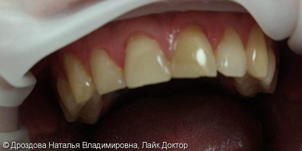 Эндодонтическое отбеливание 21 зуба - фото №1