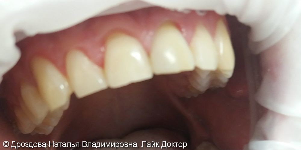 Эндодонтическое отбеливание 21 зуба - фото №2