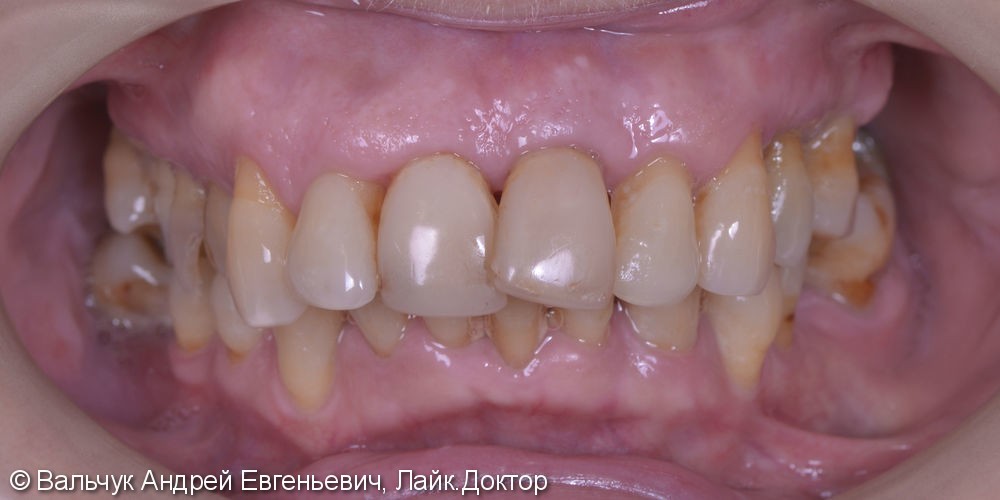 Имплантация зубов - вся челюсть! Реабилитация за 2 дня! - фото №2