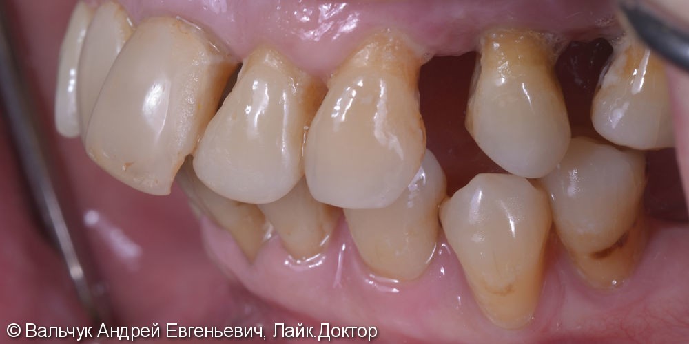 Имплантация зубов - вся челюсть! Реабилитация за 2 дня! - фото №3