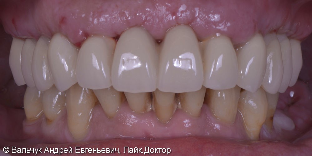 Имплантация зубов - вся челюсть! Реабилитация за 2 дня! - фото №6