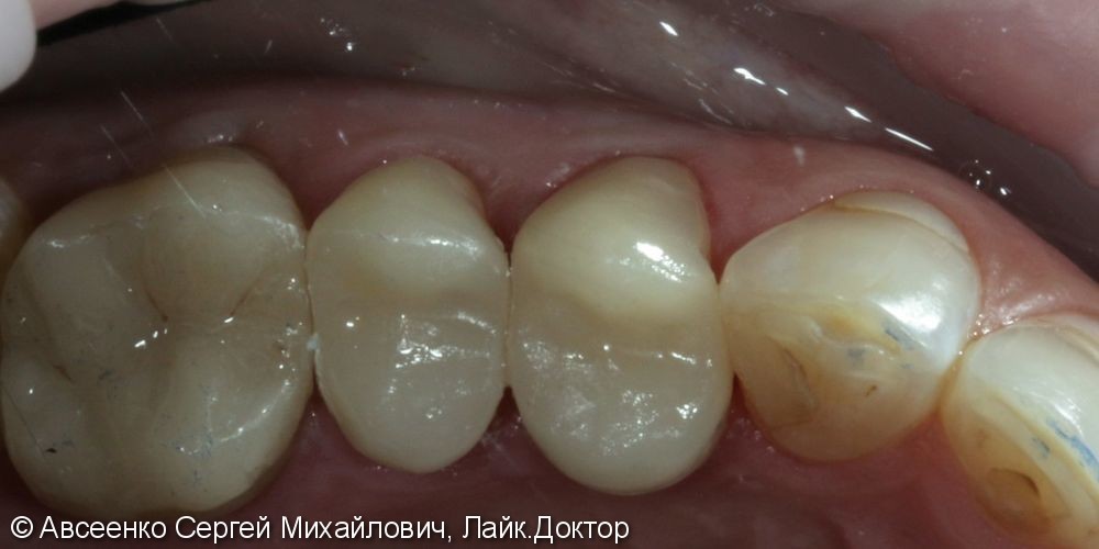 Реставрация зубов керамическими коронками - фото №5