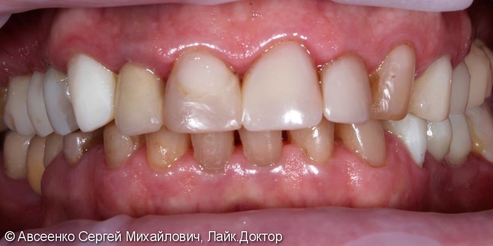 Установка керамических коронок на верхний и нижний зубные ряды - фото №1