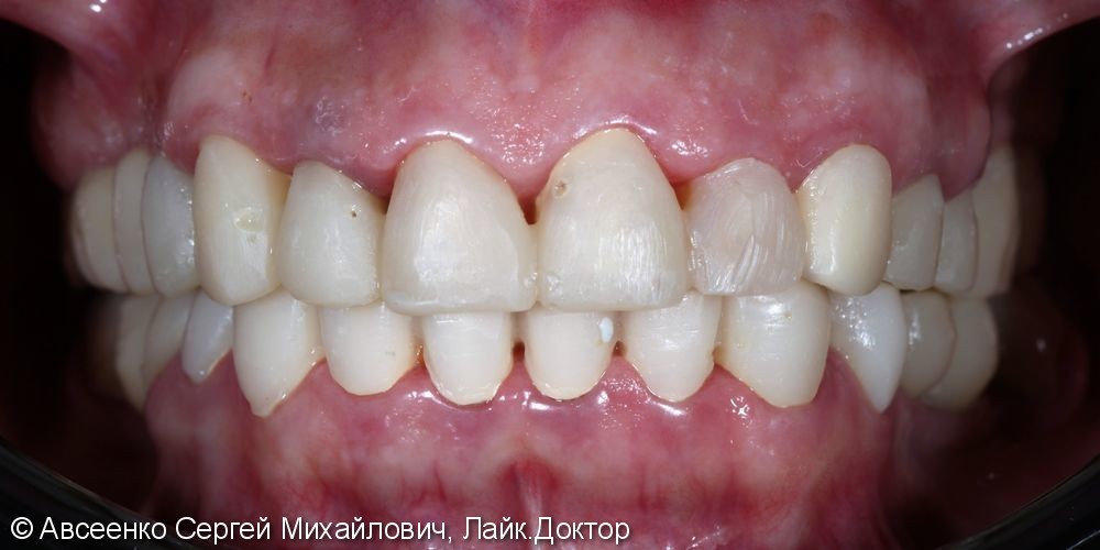 Установка керамических коронок на верхний и нижний зубные ряды - фото №3