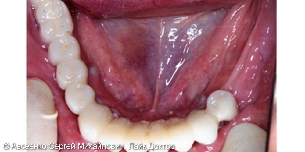 Восстановление зубов нижнего ряда (имплантация и установка безметалловых коронок на импланты) - фото №2