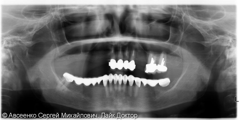 Восстановление зубов нижнего ряда (имплантация и установка безметалловых коронок на импланты) - фото №3