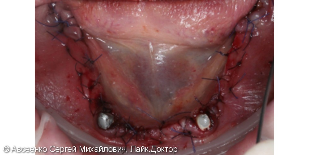 Восстановление зубов нижнего ряда (имплантация и установка безметалловых коронок на импланты) - фото №4