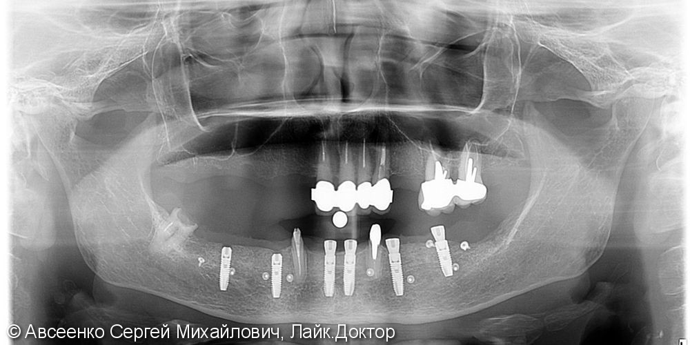 Восстановление зубов нижнего ряда (имплантация и установка безметалловых коронок на импланты) - фото №5