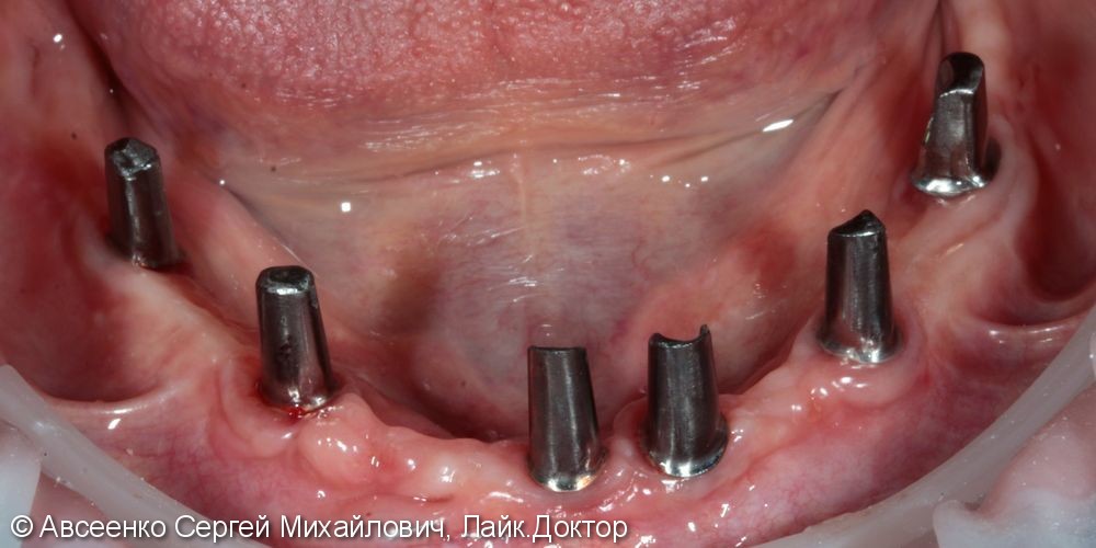 Восстановление зубов нижнего ряда (имплантация и установка безметалловых коронок на импланты) - фото №6