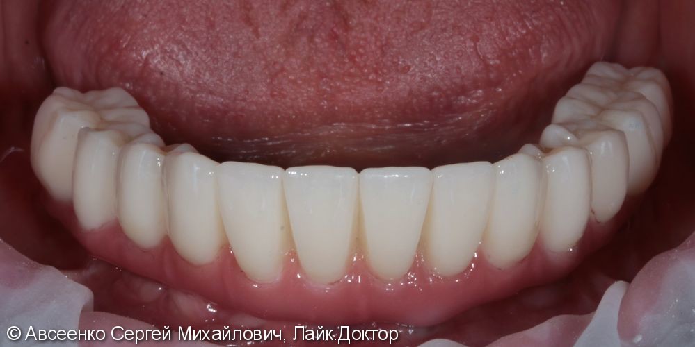 Восстановление зубов нижнего ряда (имплантация и установка безметалловых коронок на импланты) - фото №7