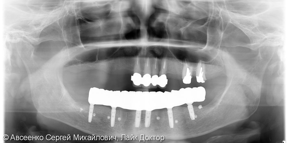 Восстановление зубов нижнего ряда (имплантация и установка безметалловых коронок на импланты) - фото №8