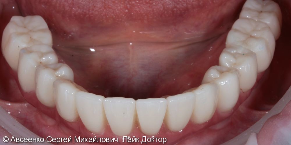 Восстановление зубов нижнего ряда (имплантация и установка безметалловых коронок на импланты) - фото №9
