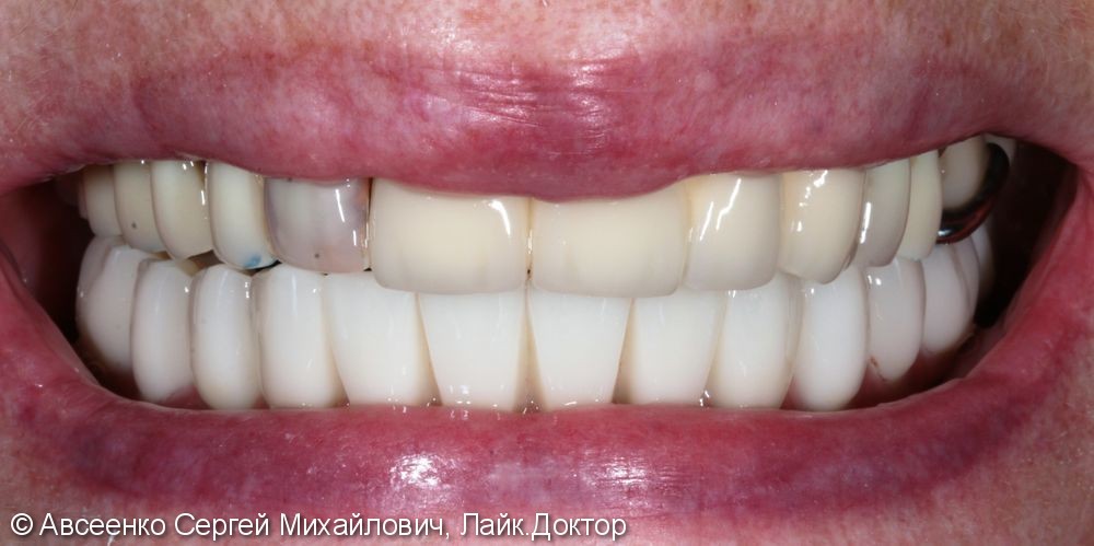 Восстановление зубов нижнего ряда (имплантация и установка безметалловых коронок на импланты) - фото №10