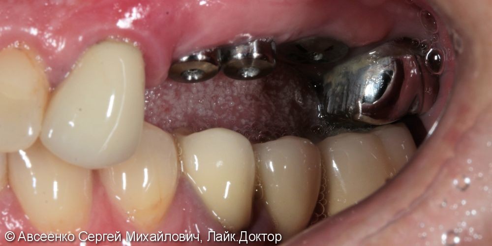 Имплантация зубов и установка коронок с опорой на имплант - фото №3