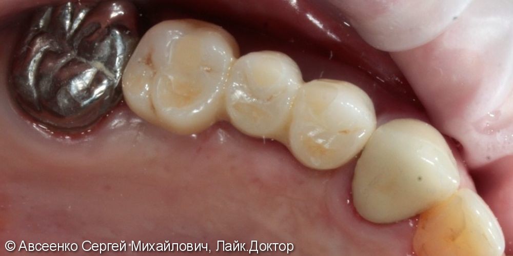 Имплантация зубов и установка коронок с опорой на имплант - фото №6