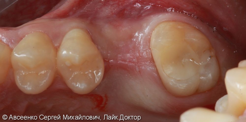 Имплантация зубов и установка коронки с опорой на имплант - фото №1