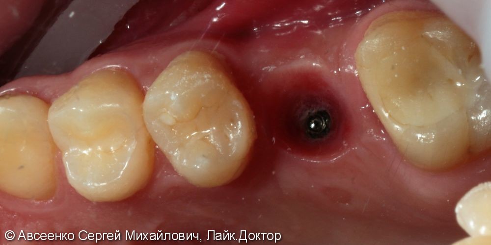 Имплантация зубов и установка коронки с опорой на имплант - фото №2