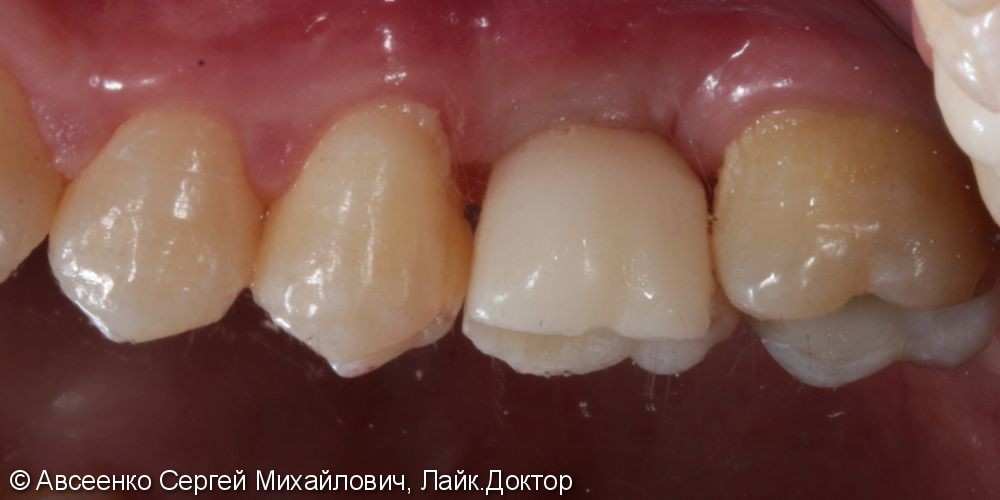 Имплантация зубов и установка коронки с опорой на имплант - фото №3