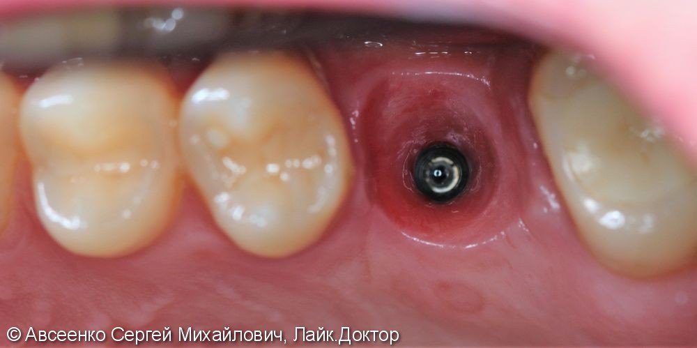 Имплантация зубов и установка коронки с опорой на имплант - фото №4
