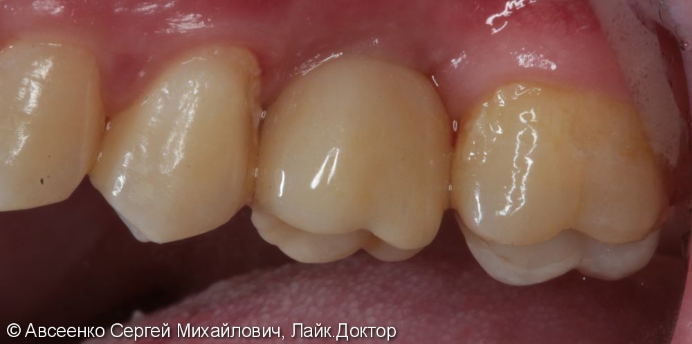 Имплантация зубов и установка коронки с опорой на имплант - фото №5
