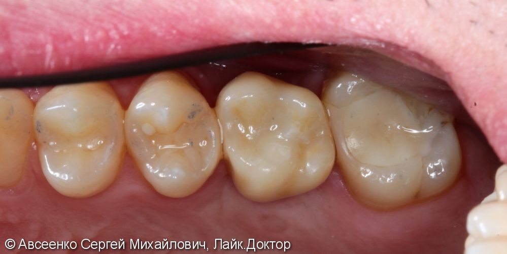 Имплантация зубов и установка коронки с опорой на имплант - фото №6