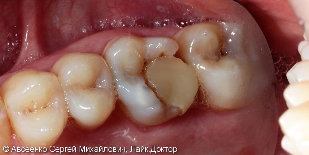 Восстановление зуба керамической реставрацией с использованием технологии CEREC - фото №1