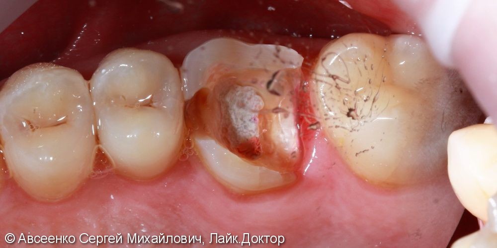 Восстановление зуба керамической реставрацией с использованием технологии CEREC - фото №2