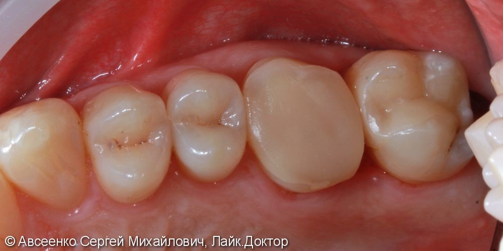 Восстановление зуба керамической реставрацией с использованием технологии CEREC - фото №3